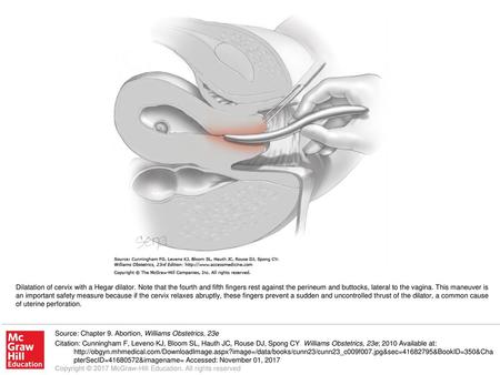 Dilatation of cervix with a Hegar dilator