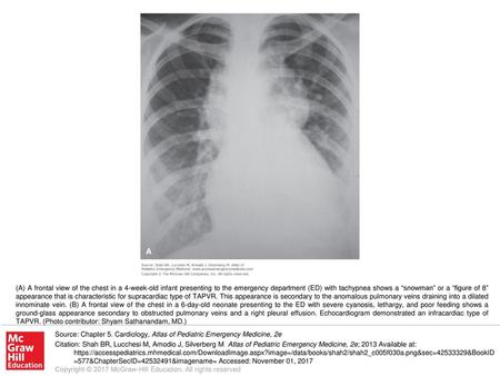 (A) A frontal view of the chest in a 4-week-old infant presenting to the emergency department (ED) with tachypnea shows a “snowman” or a “figure of 8”