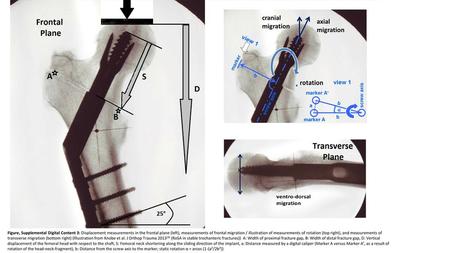 Figure, Supplemental Digital Content 3: Displacement measurements in the frontal plane (left), measurements of frontal migration / illustration of measurements.