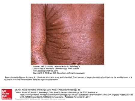 Atopic dermatitis Figures 9-14 and 9-15 illustrate skin that is scaly and lichenified. The treatment of atopic dermatitis should include the establishment.