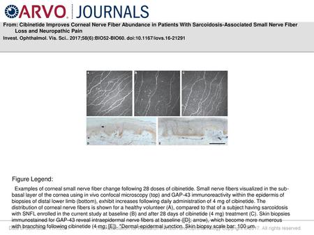 From: Cibinetide Improves Corneal Nerve Fiber Abundance in Patients With Sarcoidosis-Associated Small Nerve Fiber Loss and Neuropathic Pain Invest. Ophthalmol.