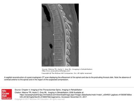 A sagittal reconstruction of a post-myelogram CT scan displaying the effacement of the spinal cord due to the protruding thoracic disk. Note the absence.