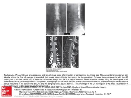 Radiographs (A) and (B) are anteroposterior and lateral views mode after injection of contrast into the thecal sac. This conventional myelogram can identify.