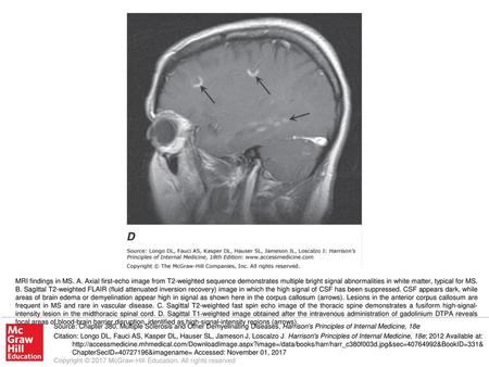 MRI findings in MS. A. Axial first-echo image from T2-weighted sequence demonstrates multiple bright signal abnormalities in white matter, typical for.