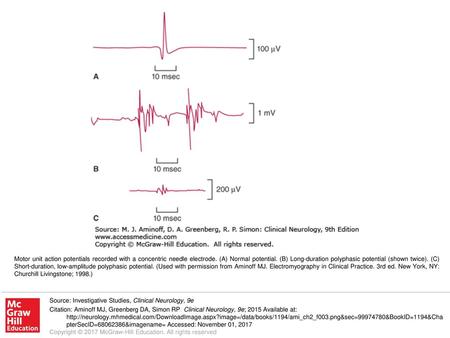 Motor unit action potentials recorded with a concentric needle electrode. (A) Normal potential. (B) Long-duration polyphasic potential (shown twice). (C)