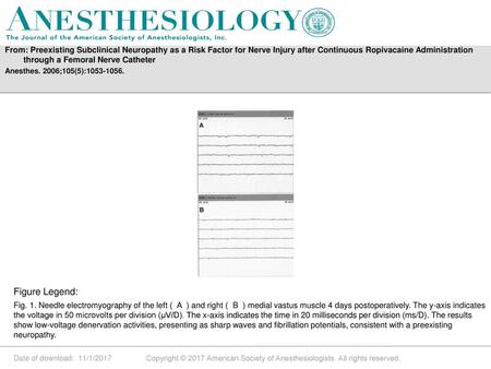 From: Preexisting Subclinical Neuropathy as a Risk Factor for Nerve Injury after Continuous Ropivacaine Administration through a Femoral Nerve Catheter.