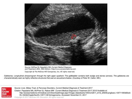 Gallstones. Longitudinal ultrasonogram through the right upper quadrant. The gallbladder contains both sludge and stones (arrows). The gallstones are characteristically.