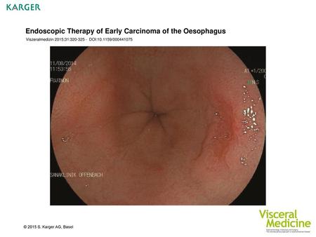 Endoscopic Therapy of Early Carcinoma of the Oesophagus