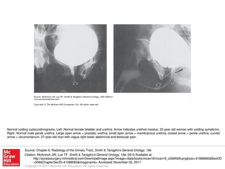 Normal voiding cystourethrograms