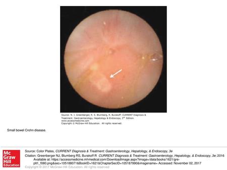 Small bowel Crohn disease.