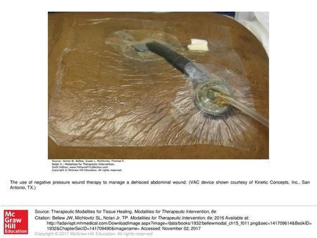 The use of negative pressure wound therapy to manage a dehisced abdominal wound. (VAC device shown courtesy of Kinetic Concepts, Inc., San Antonio, TX.)