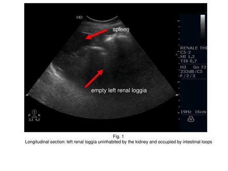 empty left renal loggia