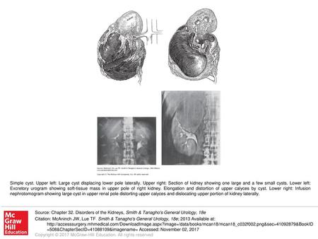 Simple cyst. Upper left: Large cyst displacing lower pole laterally