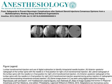 From: Safeguards to Prevent Neurologic Complications after Epidural Steroid Injections:Consensus Opinions from a Multidisciplinary Working Group and National.