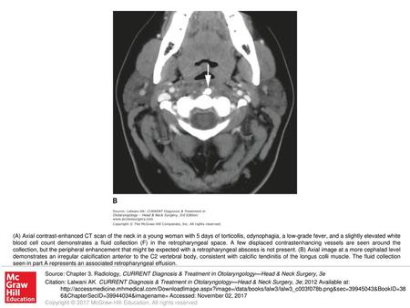 (A) Axial contrast-enhanced CT scan of the neck in a young woman with 5 days of torticollis, odynophagia, a low-grade fever, and a slightly elevated white.