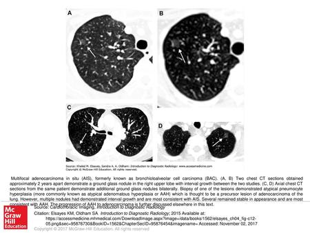 Multifocal adenocarcinoma in situ (AIS), formerly known as bronchioloalveolar cell carcinoma (BAC). (A, B) Two chest CT sections obtained approximately.