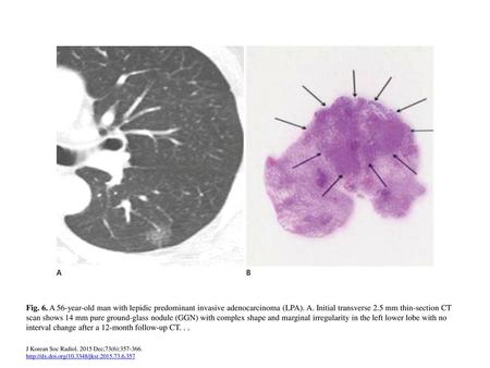 Fig. 6. A 56-year-old man with lepidic predominant invasive adenocarcinoma (LPA). A. Initial transverse 2.5 mm thin-section CT scan shows 14 mm pure ground-glass.