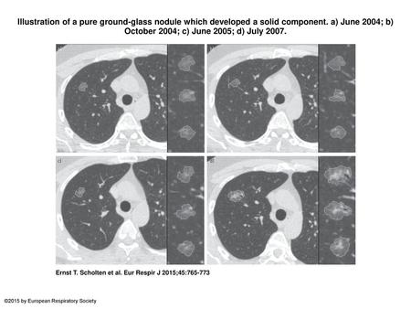 Illustration of a pure ground-glass nodule which developed a solid component. a) June 2004; b) October 2004; c) June 2005; d) July 2007. Illustration of.