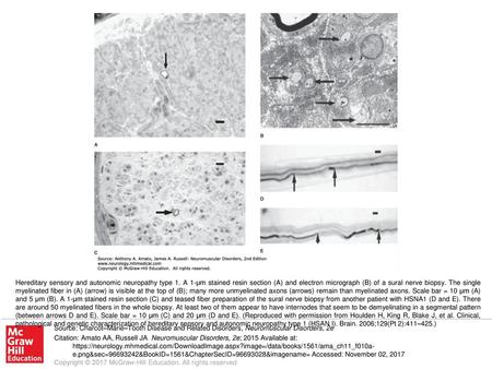 Hereditary sensory and autonomic neuropathy type 1