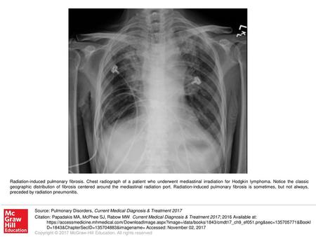 Radiation-induced pulmonary fibrosis