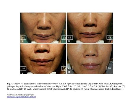 Fig. 4. Subject (61 years/female) with dermal injection of HA-P in right nasolabial fold (NLF) and HA-G in left NLF. Genzyme 6-point grading scale change.