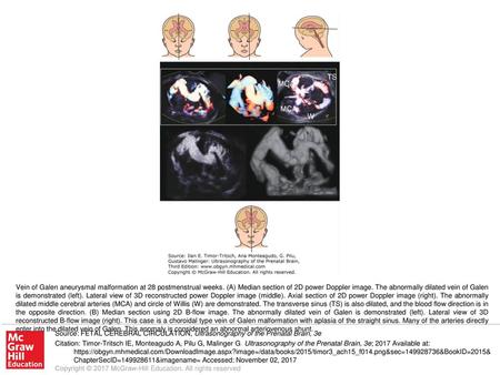 Vein of Galen aneurysmal malformation at 28 postmenstrual weeks