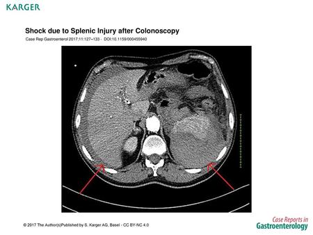 Shock due to Splenic Injury after Colonoscopy