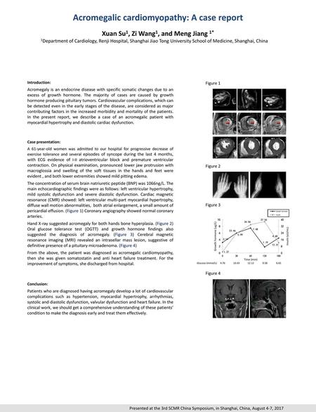 Acromegalic cardiomyopathy: A case report