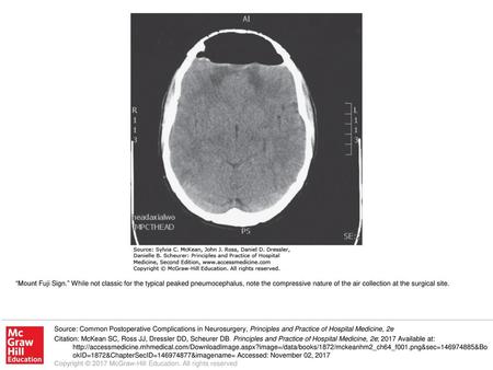 “Mount Fuji Sign.” While not classic for the typical peaked pneumocephalus, note the compressive nature of the air collection at the surgical site. Source: