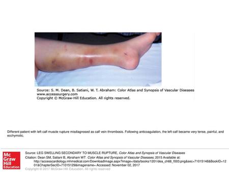 Different patient with left calf muscle rupture misdiagnosed as calf vein thrombosis. Following anticoagulation, the left calf became very tense, painful,