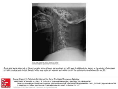 Cross-table lateral radiograph of the cervical spine shows a flexion teardrop injury at the C5 level. In addition to the fracture of the anterior, inferior.