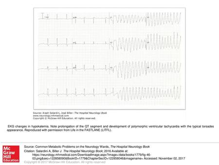 EKG changes in hypokalemia