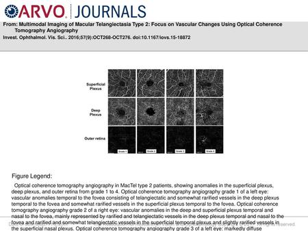 From: Multimodal Imaging of Macular Telangiectasia Type 2: Focus on Vascular Changes Using Optical Coherence Tomography Angiography Invest. Ophthalmol.