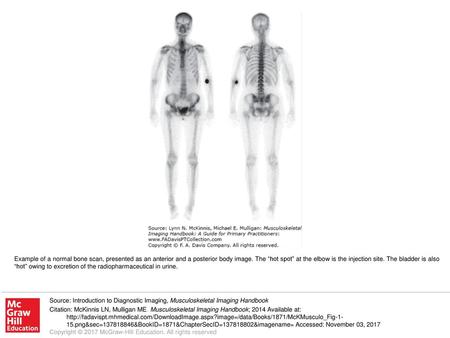 Example of a normal bone scan, presented as an anterior and a posterior body image. The “hot spot” at the elbow is the injection site. The bladder is also.