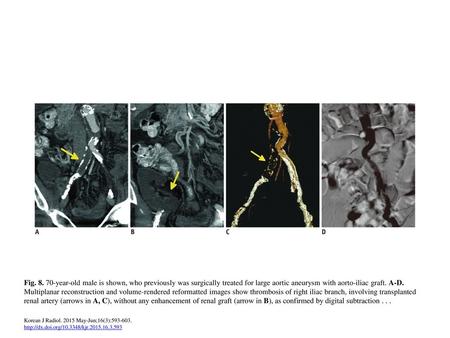 Fig. 8. 70-year-old male is shown, who previously was surgically treated for large aortic aneurysm with aorto-iliac graft. A-D. Multiplanar reconstruction.