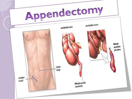 Appendectomy.