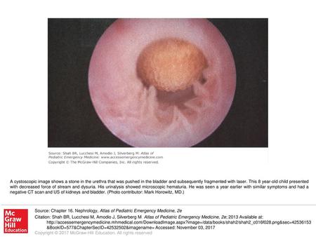 A cystoscopic image shows a stone in the urethra that was pushed in the bladder and subsequently fragmented with laser. This 8 year-old child presented.