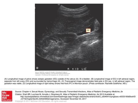 (A) Longitudinal image of pelvis shows ectopic gestation (EG) outside of the uterus (U). B is bladder. (B) Longitudinal image of EG in left adnexal region,