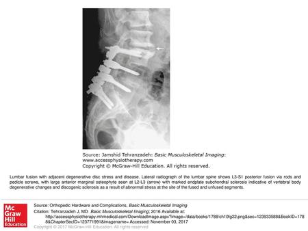 Lumbar fusion with adjacent degenerative disc stress and disease