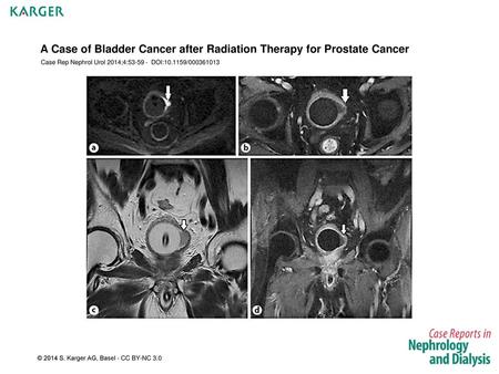 A Case of Bladder Cancer after Radiation Therapy for Prostate Cancer