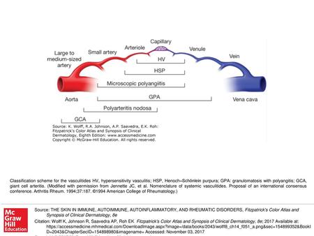 Classification scheme for the vasculitides HV, hypersensitivity vasculitis; HSP, Henoch–Schönlein purpura; GPA: granulomatosis with polyangitis; GCA, giant.