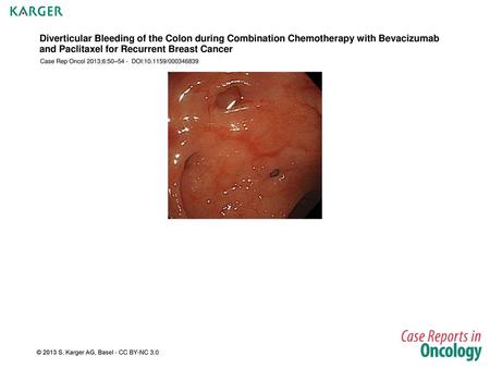 Diverticular Bleeding of the Colon during Combination Chemotherapy with Bevacizumab and Paclitaxel for Recurrent Breast Cancer Case Rep Oncol 2013;6:50–54.