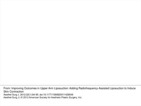 Figure 8. (A) This 63-year-old woman presented with a Stage 4 upper arm deformity. (B) One year after radiofrequency-assisted liposuction upper arm contouring,