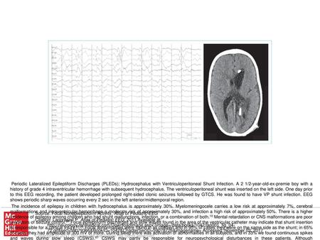 The incidence of epilepsy in children with hydrocephalus is approximately 30%. Myelomeningocele carries a low risk at approximately 7%, cerebral malformations.