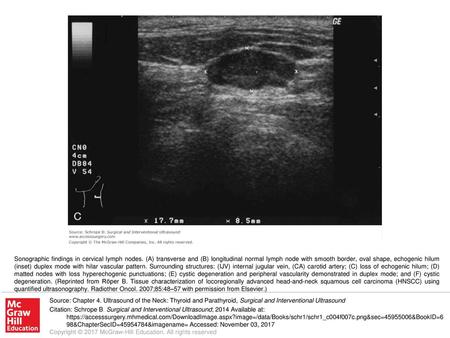 Sonographic findings in cervical lymph nodes