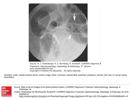 Ulcerative colitis. Double-contrast barium enema image shows numerous contrast-filled superficial ulcerations (arrows) with loss of normal colonic haustrations.