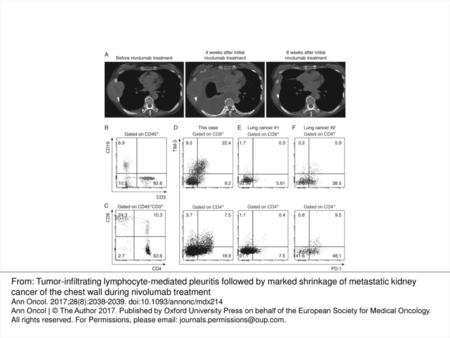 Figure 1 (A) Chest computed tomography scans of the patient