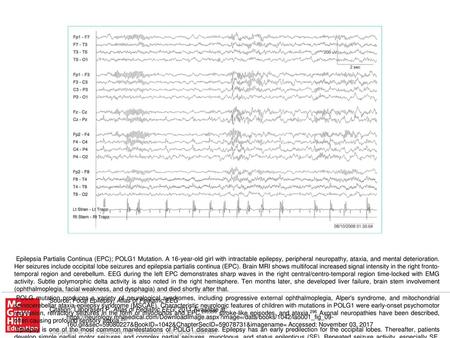 POLG1 mutations should be considered in teenagers and young adults reporting episodic visual symptoms with migraine-like headaches and sudden-onset intractable.