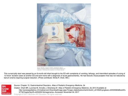 This currant-jelly stool was passed by an 8-month-old infant brought to the ED with complaints of vomiting, lethargy, and intermittent episodes of crying.