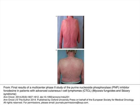 Figure 2. (A) Sézary syndrome patient before treatment